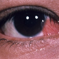 Pterygium