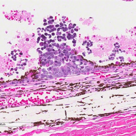 A clump of retinoblastoma cells
