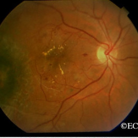 Choroidal Melanoma