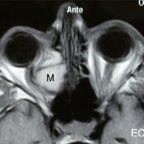 Ethmoidal mucocele (M) displacing the optic nerve