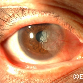 Pterygium