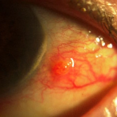 Pyogenic granuloma of the bulbar conjunctiva