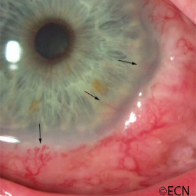 Squamous carcinoma of the conjunctiva