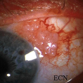 Squamous carcinoma of the conjunctiva