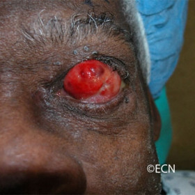 Squamous carcinoma of the conjunctiva with orbital extension.