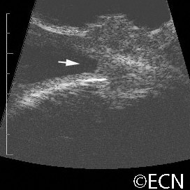 Squamous carcinoma with intraocular invasion