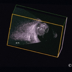 3D ultrasound of a retinoblastoma