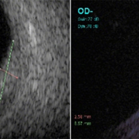 Choroidal Hemangioma