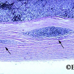 Choroidal Melanoma
