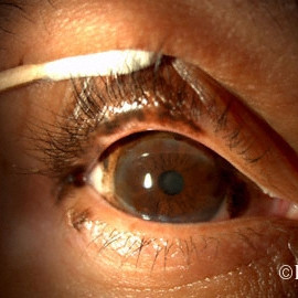 Eyelid Melanoma