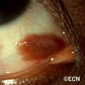 Squamous Conjunctival Papilloma
