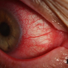 Topical mitomycin chemotherapy related chemical blepharitis and conjunctivitis