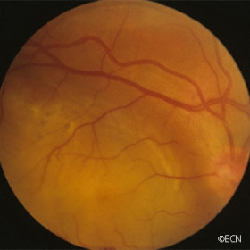 Choroidal metastasis from a lung