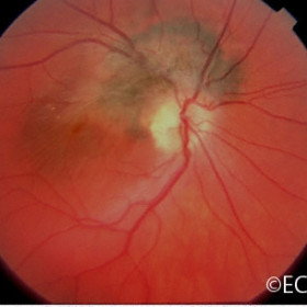 Combined hamartoma of the retinal pigment epithelium