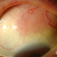Conjunctival lymphoma