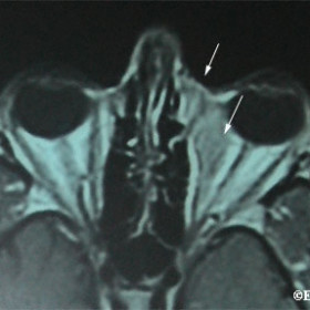 Nasal orbital lymphoma with subcutaneous extension