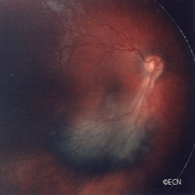 Combined hamartoma of the retinal pigment epithelium