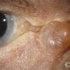 Hydrocystoma at the medial canthus