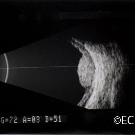 Choroidal hemangioma