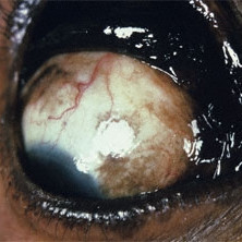 Conjunctival melanoma