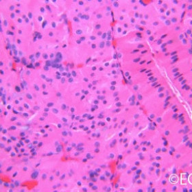 Epibulbar Oncocytoma