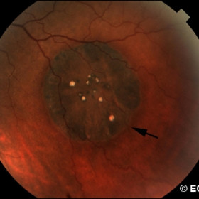 Hypertrophy of the retinal pigment epithelium