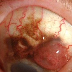 Conjunctival Melanoma with PAM