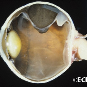Gross pathologic specimen