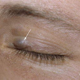 Lymphangioma of the eyelid