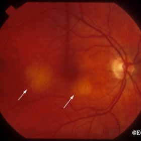 Multifocal choroidal metastasis