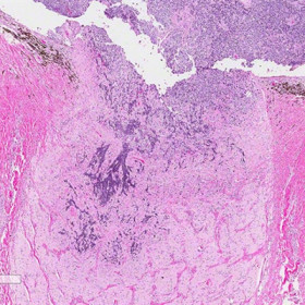 Retinoblastoma