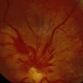 Optic sub retinal