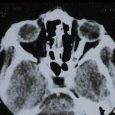 Computed tomography of the optic nerve sheath meningioma.