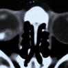 CT scan of a retinoblastoma