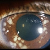 "Seeds" of retinoblastoma