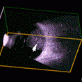 3D Ultrasound Image