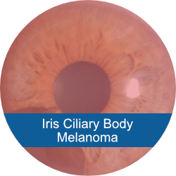 Iris Ciliary Body Melanoma Treatment Outcomes