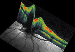 Spectral OCT/SLO is able to generate a 3-dimensional retinal thickness map