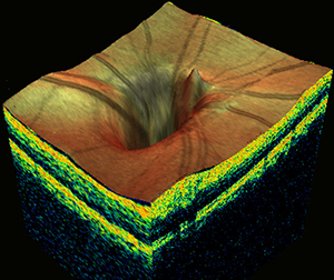 OCT creates 3D images that allows Dr. Finger to virtually "peel back" the layers of the retina.