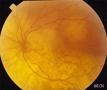 Choroidal Tumors Image Gallery » New York Eye Cancer Center