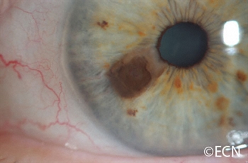 The day after the 1 mm incision "FIT" biopsy, a slit lamp photograph shows the partial thickness biopsy of the tumor.