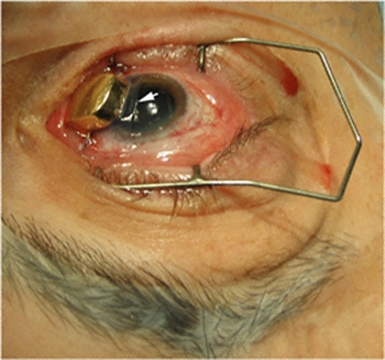Amniotic Membrane Graft on the Cornea (Arrow) affixed beneath a Custom Gold Eye Plaque