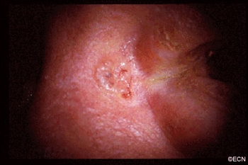 A basal cell carcinoma anterior to the medial canthus: Note the pearly margins and the central crater.