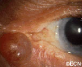An intradermal epithelial-lined serous cyst. 