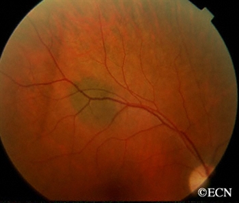 A benign appearing choroidal nevus (eye freckle).