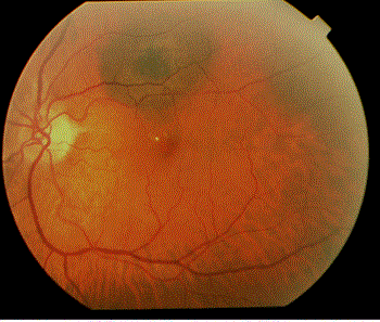 This image demonstrates how a suspicious choroidal nevus can demonstrate focal leakage on fluorescein angiography.