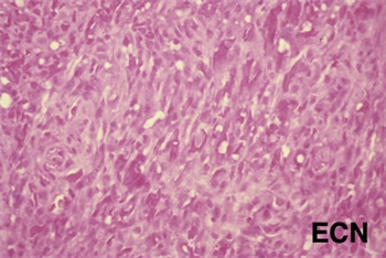 Histopathology of the excised Kaposi's sarcoma reveals myriads of vascular channels. 
