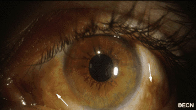 diffuse-multifocal-primary-acquired-melanosis-new-york-eye-cancer-center