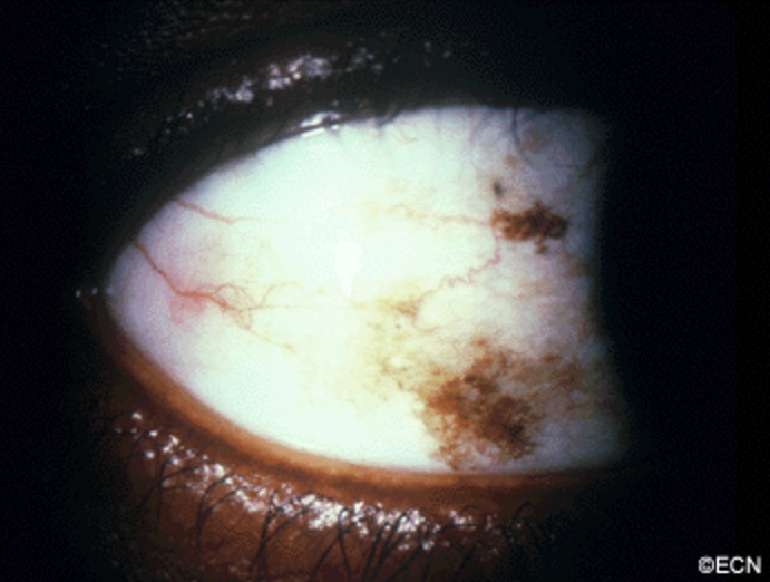 Conjunctival Melanosis: Review of the Literature