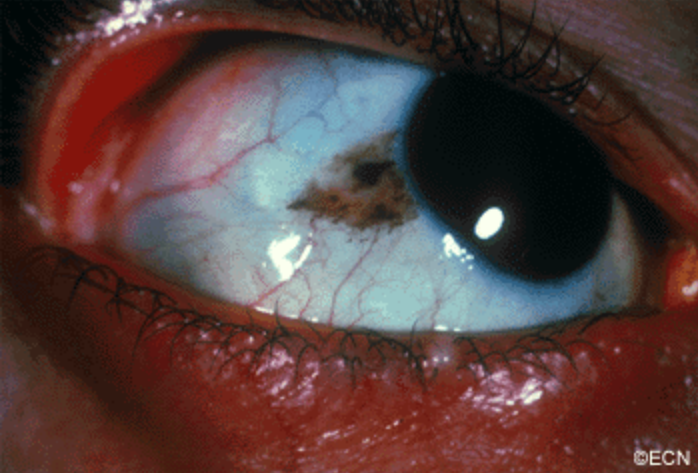 Eye - Benign melanosis - Pathology Outlines